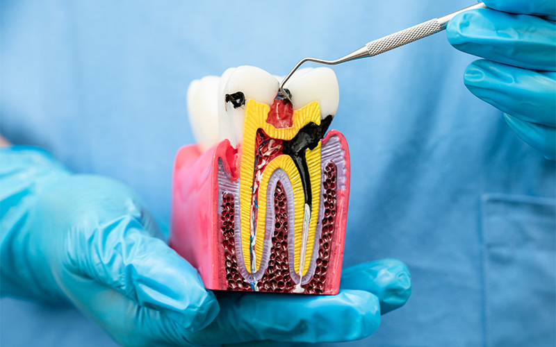 Dentist pointing at tooth model demonstrating decay assessment.