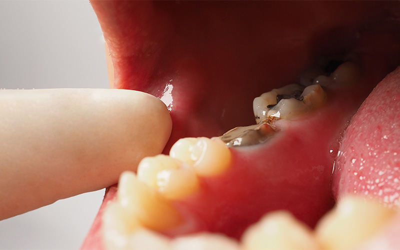 Close-up examination of a cavity on a lower molar