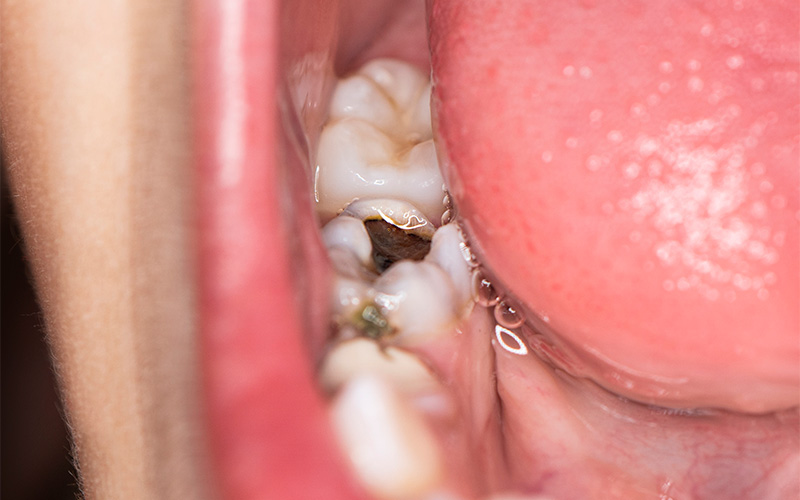 Which Type of Dental Filling Is Best? How Dentists Choose