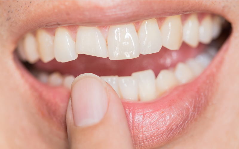 Chipped a Tooth? How to Know If You Need Urgent Dental Care