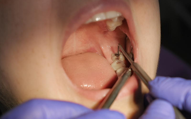 Dentist-examining-tooth-cavity-causing-pain-from-sweets